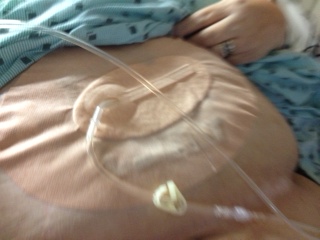 Negative pressure wound therapy pump, canister and dressing application photo